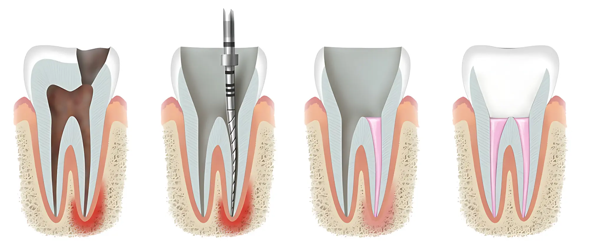 Kanal Müalicəsi (Endodontiya)